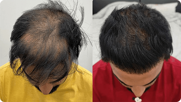 Before and after views of a man with hair loss and post-treatment fuller black hair, illustrating treatment results