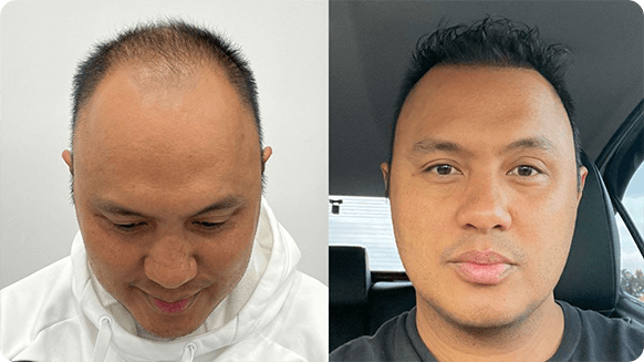 Side-by-side comparison of a man before and after hair restoration, with visible hair regrowth on the right