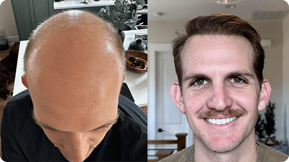 Before and after comparison of a man's hair growth, left side showing baldness and right side showing full brown hair