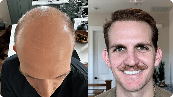 Before and after comparison of a man's hair growth, left side showing baldness and right side showing full brown hair