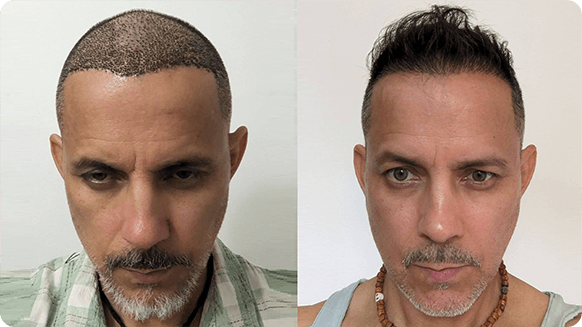 Before and after photos showing male pattern baldness and after hair transplant treatment with significantly more hair