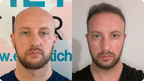 Comparison of man pre and post hair loss treatment, with noticeable hairline restoration and density increase