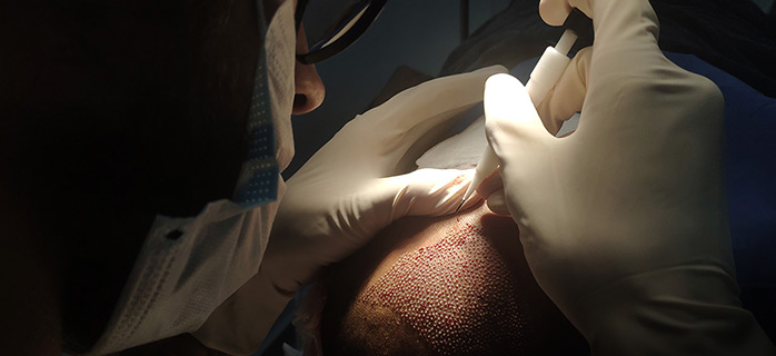 This image shows a close-up of a doctor performing a hair transplant using the **Direct Hair Implantation (DHI)** technique. The gloved hands are precisely placing hair grafts into the scalp using a Choi pen tool, illuminated by focused lighting. The scene emphasizes the precision and meticulous care involved in the procedure.