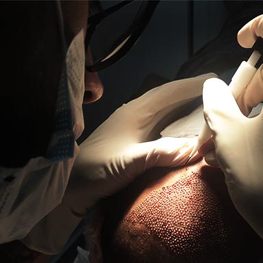 This image captures a close-up of a medical professional performing a hair transplant using the **Direct Hair Implantation (DHI)** technique. The gloved hands hold specialized tools as individual hair follicles are implanted into the scalp under focused lighting. The scene emphasizes precision and the meticulous nature of the procedure.