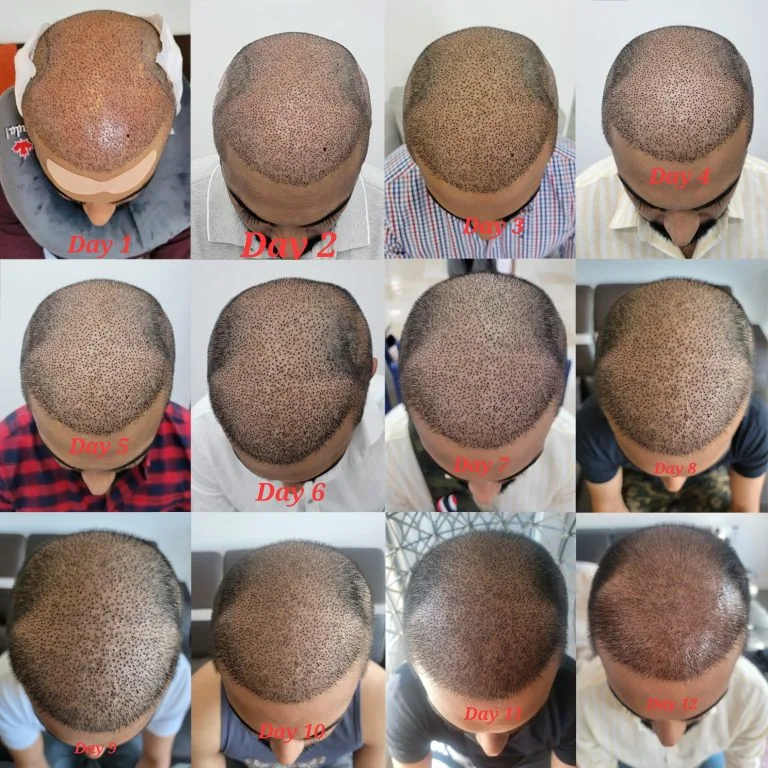 This collage displays a progression of hair growth over 12 days following a hair transplant procedure. Each image, labeled with the respective day, shows the top view of the scalp, documenting gradual healing and the development of hair follicles from day 1 to day 12