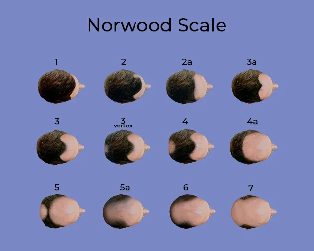 This image illustrates the Norwood Scale, a standardized classification system used to measure the progression of male pattern baldness. It features 12 stages, labeled 1 through 7