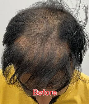 This image shows the top view of a man’s scalp before undergoing a hair transplant procedure, with visible thinning and significant hair loss. The text "Before" is prominently displayed in red at the bottom, emphasizing the pre-treatment condition