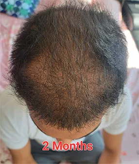 Image shows the top view of a man’s scalp two months after a hair transplant procedure, with early signs of hair regrowth visible across the treated area.