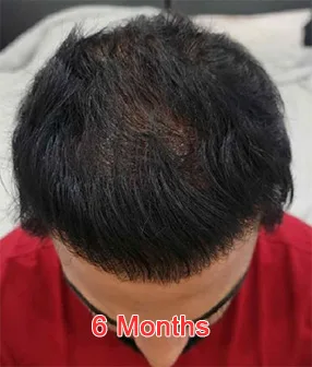 This image shows the top view of a man’s scalp six months after a hair transplant procedure, with visible hair growth and improved density