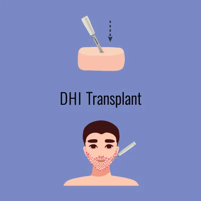 Vector illustration of beard hair transplant using the DHI method. Close-up of the transplantation process with a smaller illustration of a human head