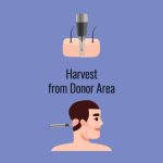 Vector illustration showing the process of harvesting grafts from the occipital area for further transplantation into the beard