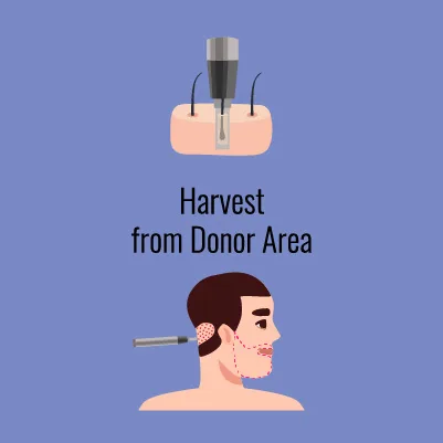 Vector illustration showing the process of harvesting grafts from the occipital area for further transplantation into the beard