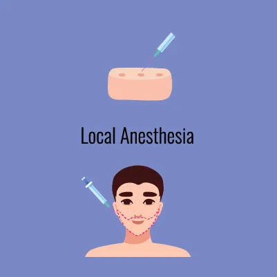 Illustration showing local anesthesia being applied, with a syringe injecting into a block of tissue above and a syringe applying anesthesia to the face of a man with dotted lines marking the beard transplant area