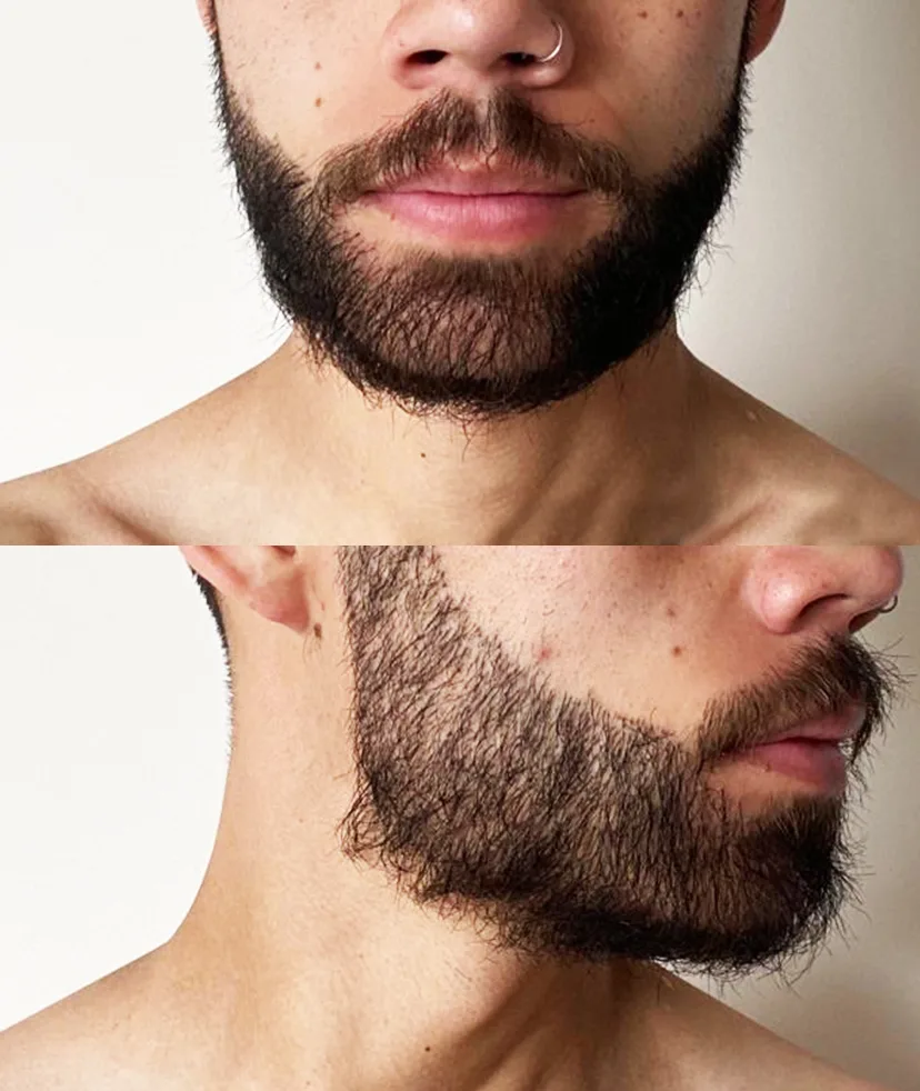 Nearby close-ups of a man's beard. Both images show a beard 6 months after hair transplant