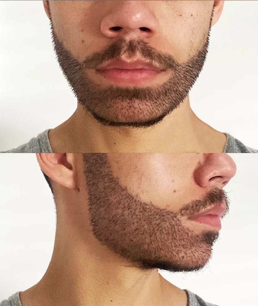 Transplantasi Rambut Jenggot Indonesia | Solusi Jenggot Lebat | GLOJAS Jakarta