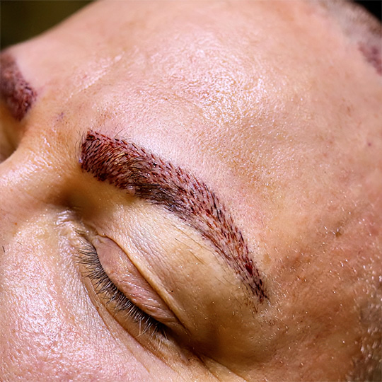 Close-up photo of a man with his eyes closed, showing his eyebrows prepared for an FUE hair transplant. Small dotted scars are visible on the eyebrow area, indicating previous follicular extraction sites.