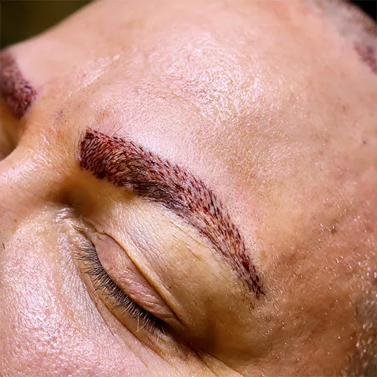 Close-up photo of a man with his eyes closed, showing his eyebrows prepared for an FUE hair transplant. Small dotted scars are visible on the eyebrow area, indicating previous follicular extraction sites.