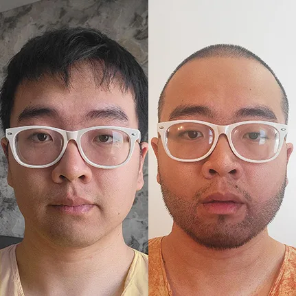 Image of a man wearing white glasses, showing a before and after comparison of a beard transplant procedure