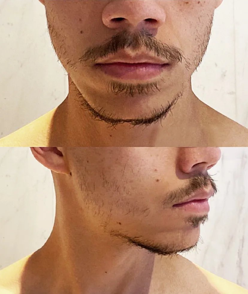 Side-by-side close-up images of a man's beard. The first image shows a sparse beard with patchy growth, while the second image highlights similar sparse areas.