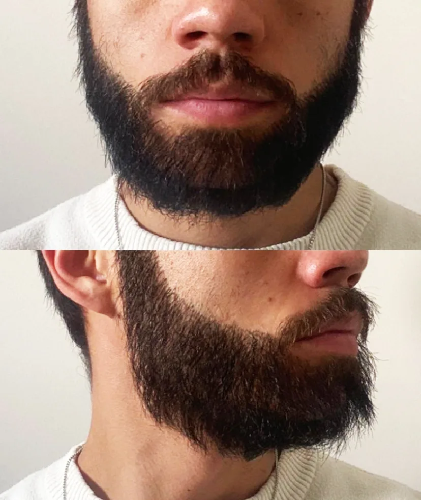 Close-up photo of a man's thick and full beard, showing the results one year after a hair transplant procedure