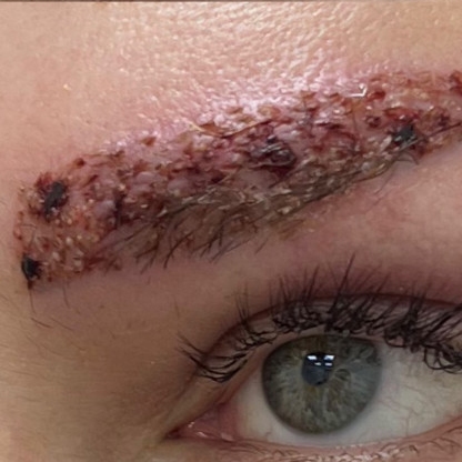 Macro photograph showing close-up of scabs on healing skin, highlighting the natural texture and crusted areas formed during the recovery process