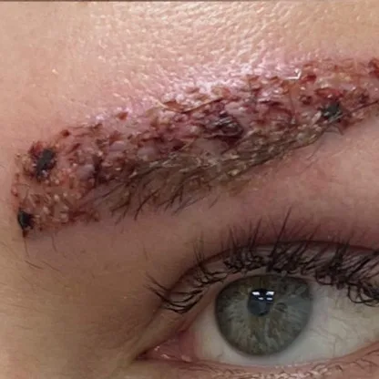 Macro photograph showing close-up of scabs on healing skin, highlighting the natural texture and crusted areas formed during the recovery process