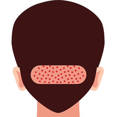illustration-showing-donor-area-on-back-of-head-prepared-for-graft-extraction-in-eyebrow-transplant-procedure