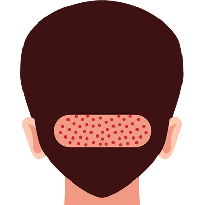 illustration-showing-donor-area-on-back-of-head-prepared-for-graft-extraction-in-eyebrow-transplant-procedure