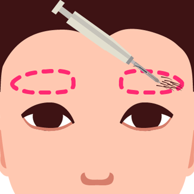 Eyebrow transplant procedure, showing hair grafts being implanted into the brow area for natural restoration