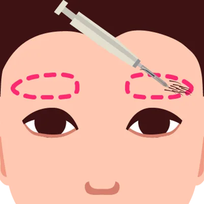 Eyebrow transplant procedure, showing hair grafts being implanted into the brow area for natural restoration