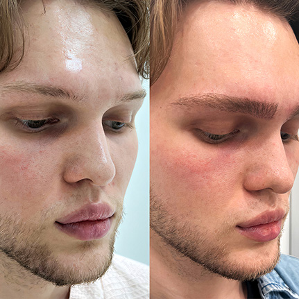 Before and after photograph of a male face showing eyebrow transplant results. The left side displays a lightly defined eyebrow, while the right side shows a fuller, well-shaped eyebrow with enhanced density and form after the transplant