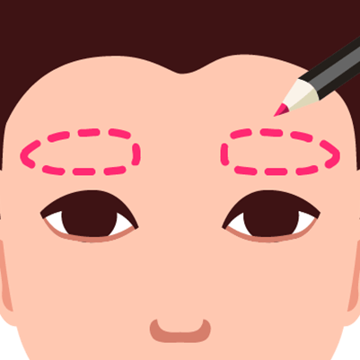 Eyebrow transplant design phase, showing red marker outlining the desired eyebrow shape on a portion of the head