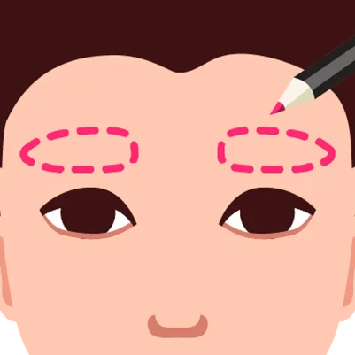 Eyebrow transplant design phase, showing red marker outlining the desired eyebrow shape on a portion of the head