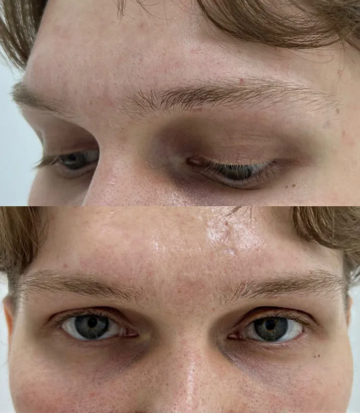 Close-up shots of a young man's eyebrows, showcasing light brown hair Includes a full-face view and a three-quarter angle, captured before undergoing a hair transplant, emphasizing the starting condition of his natural brows