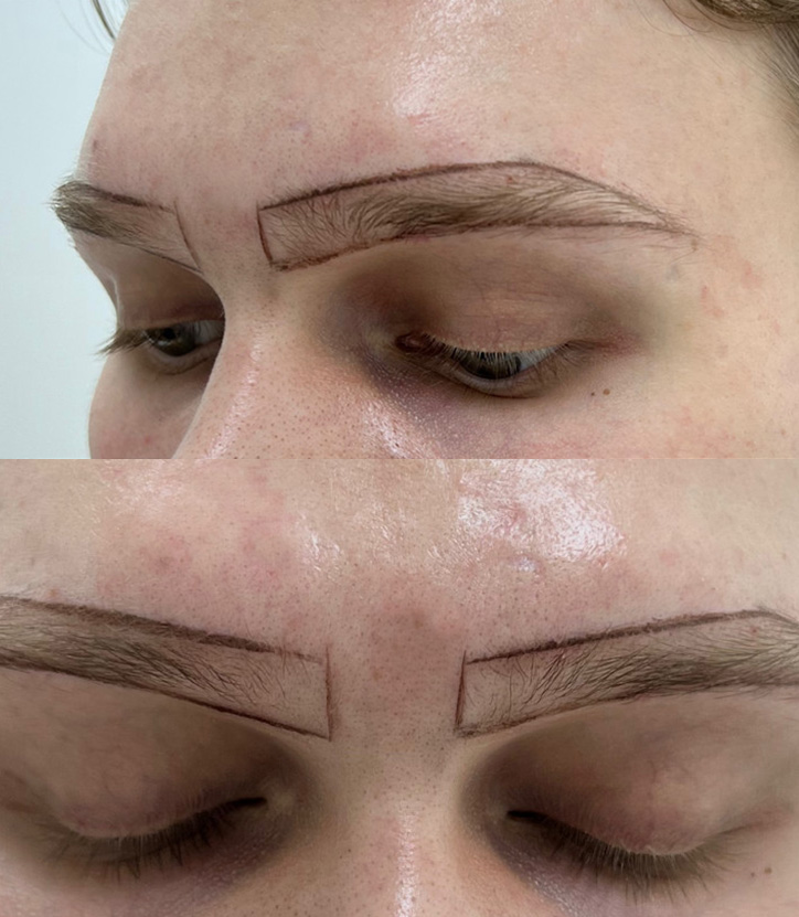 Close-up a young man with a black marker outline drawn on his forehead, marking the desired shape of his future eyebrows before a hair transplant. The outlined shape is bold and precise, giving a clear preview of the intended transformation.