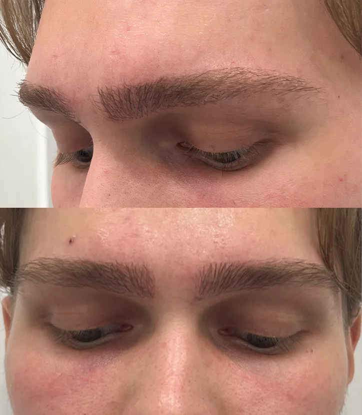 Close-up photo of a young man's eyebrows one year after a hair transplant, showing dense, even hair growth and a natural shape, highlighting the success of the procedure.
