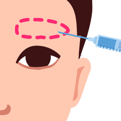 Vector image showing local anesthesia injection around the marked brow area in preparation for eyebrow transplant surgery