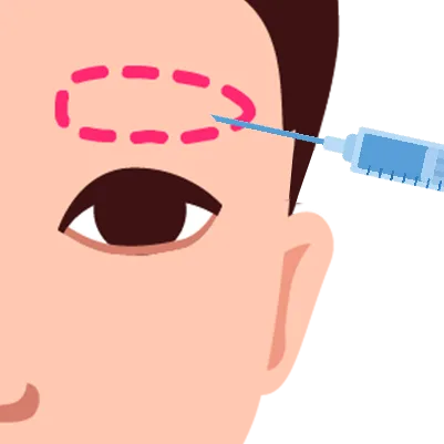 Vector image showing local anesthesia injection around the marked brow area in preparation for eyebrow transplant surgery