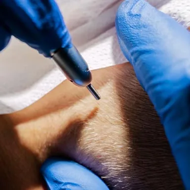 A close-up of a hair transplant procedure using the FUE (Follicular Unit Extraction) micro motor technique