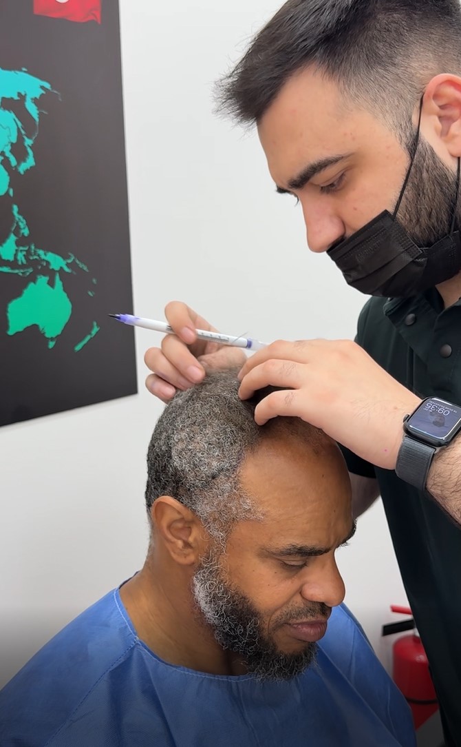 Hair transplant doctor marking the hairline on a patient before surgery in a clinical setting