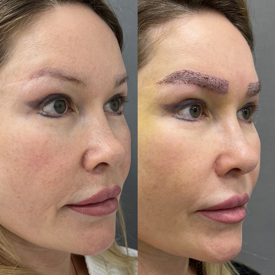 Early result after eyebrow transplant showing restored density and natural arch design