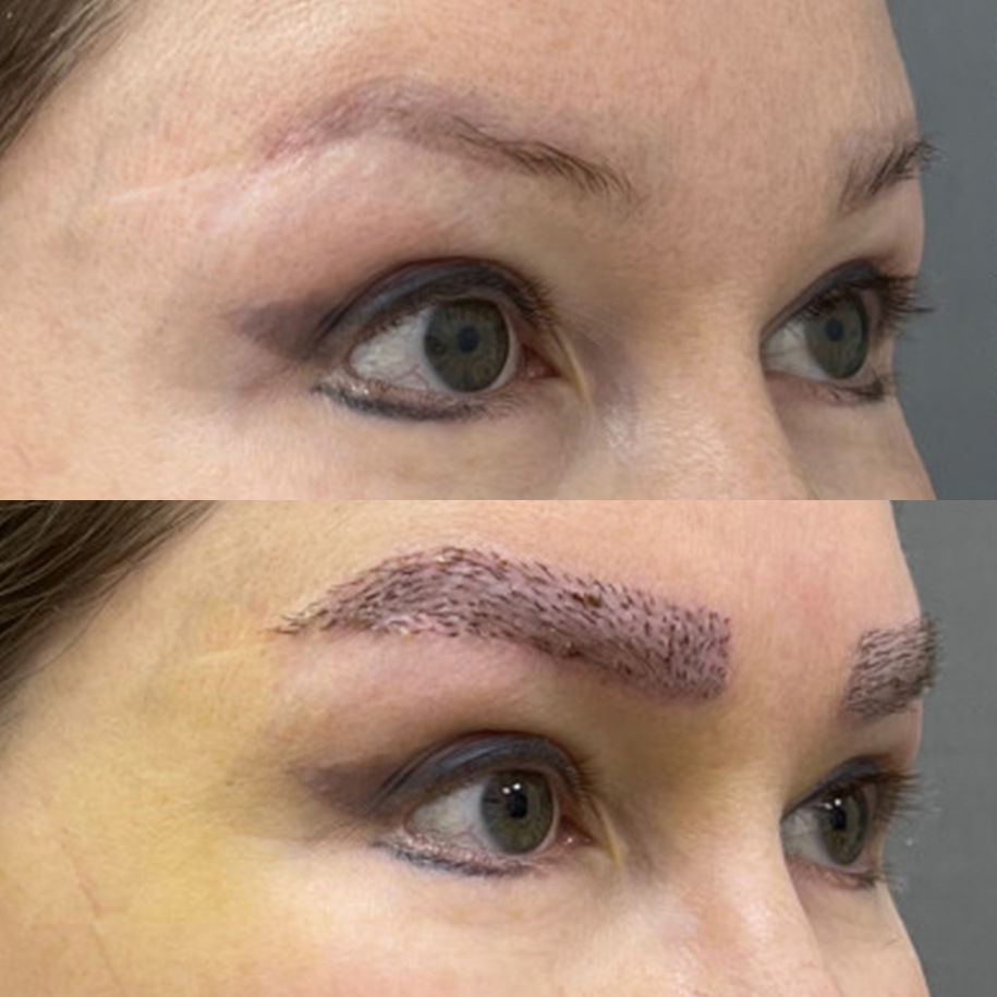 Before eyebrow transplant for woman with low density and uneven shape