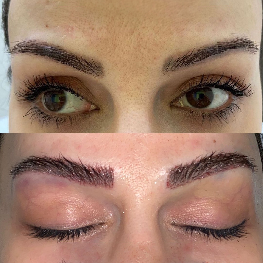 Before and after eyebrow transplant using FUE technique early healing stage