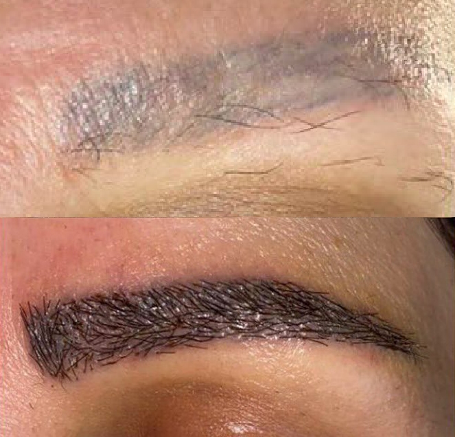 Before and after full eyebrow reconstruction using FUE technique early healing stage with high graft density