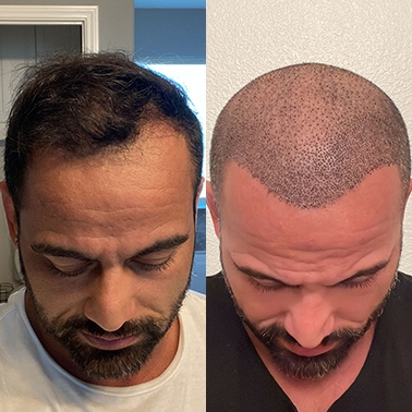 Male hair transplant before and after comparison demonstrating hairline reconstruction