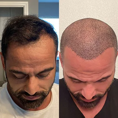 Male hair transplant before and after comparison demonstrating hairline reconstruction