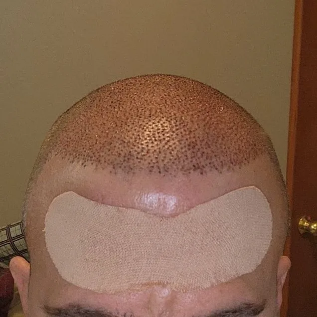 Immediate post-operative male hair transplant result