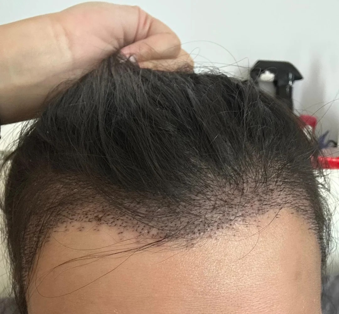 Female hair transplant result showing frontal hairline density restoration after DHI procedure