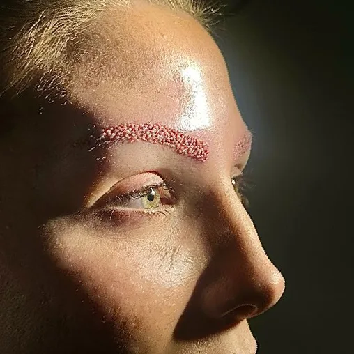 Female eyebrow transplant result showing natural brow density restoration and refined shape