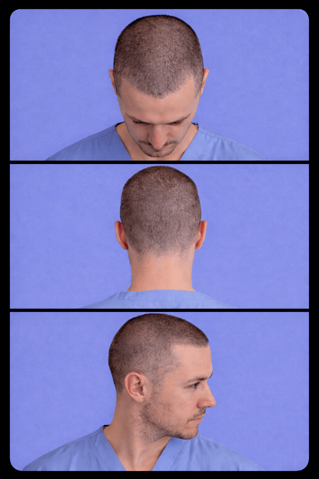 Hair transplant donor area front back and side view